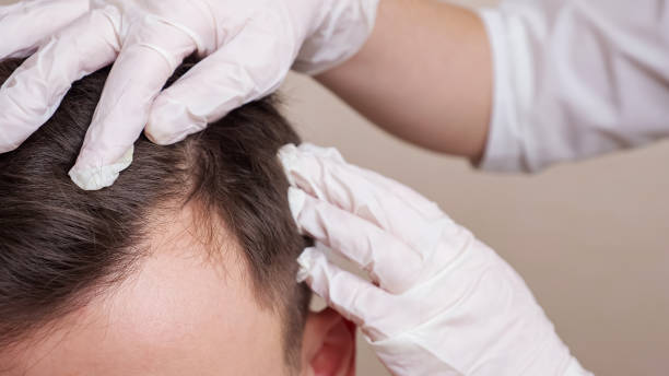 Hair Loss Treatment: Scalp Micropigmentation Benefits